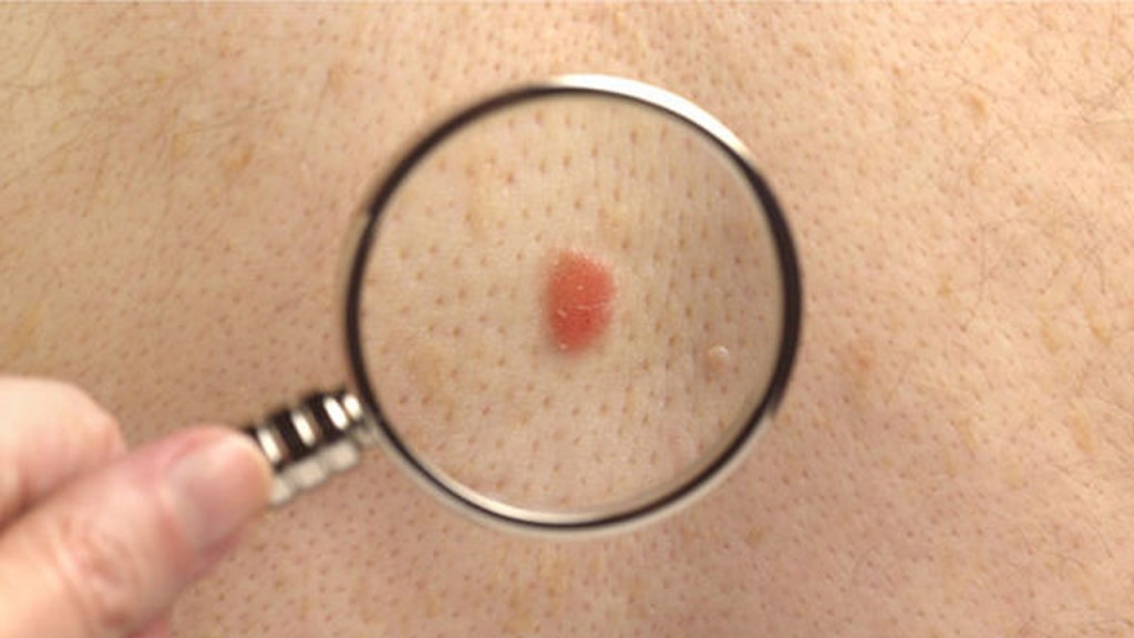 melanoma_contenido1